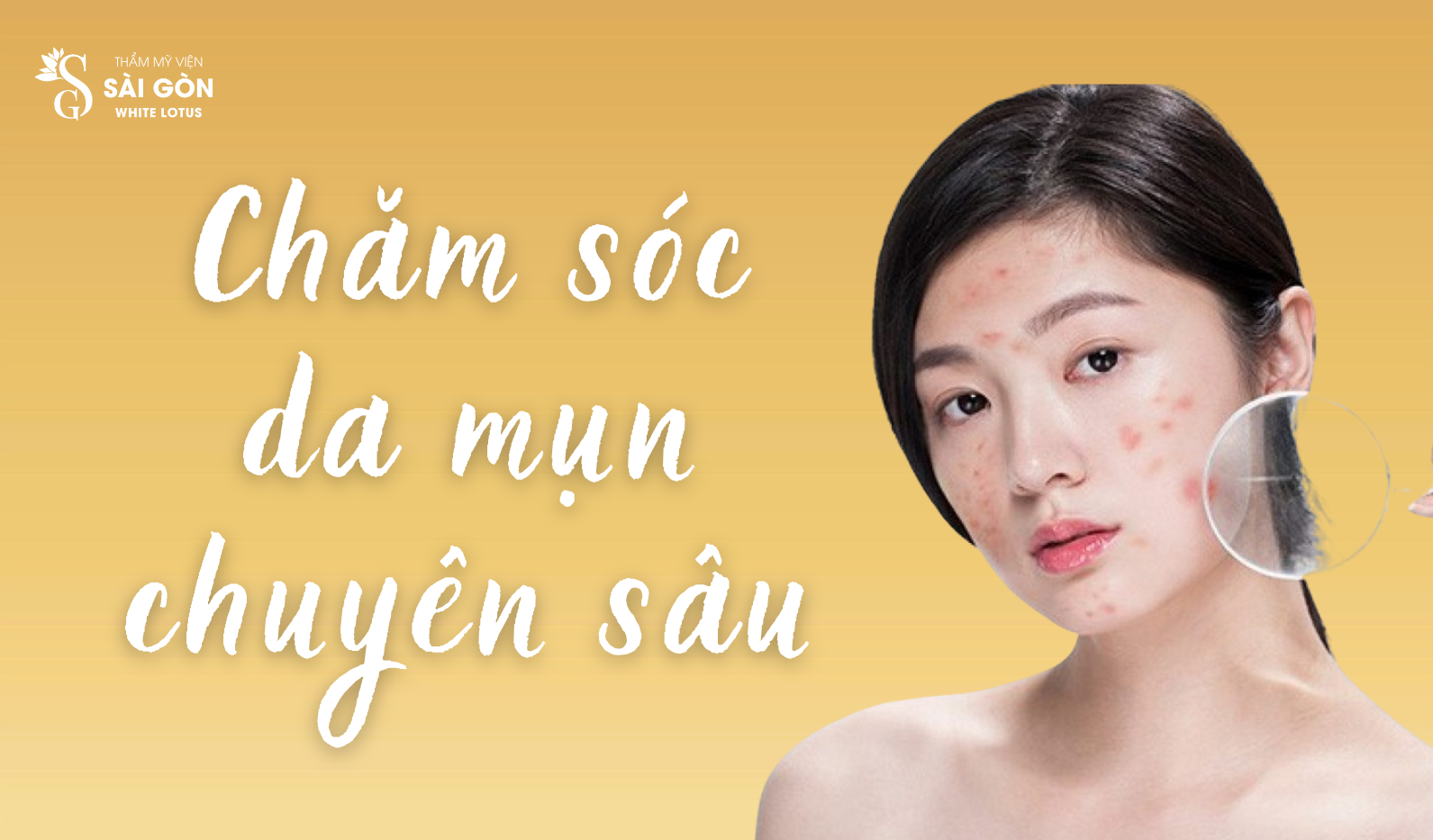Chăm sóc da mụn chuyên sâu tại WhiteLotus
