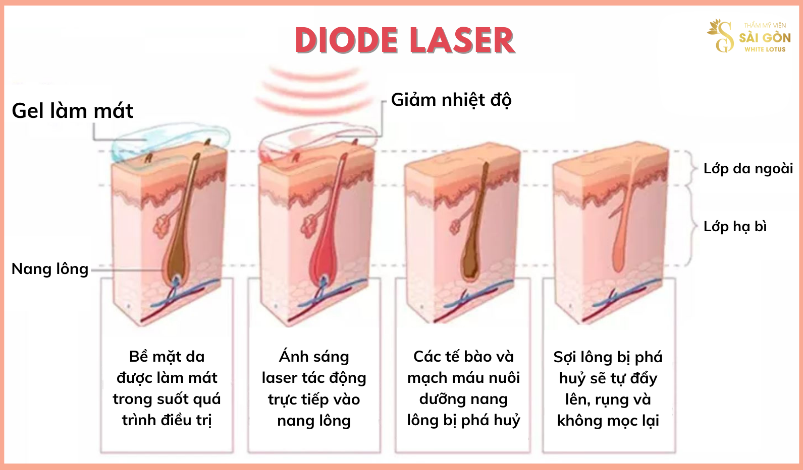 Triệt lông bằng công nghệ Diode Laser